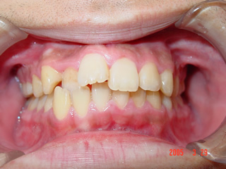 叢生（八重歯）の矯正治療前