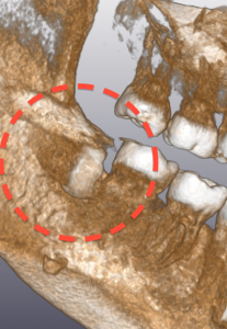 CT　埋伏歯　02