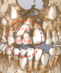 乳歯による前歯の萌出障害