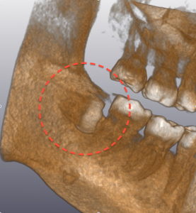 CT 埋伏歯　03