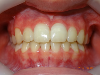 叢生（八重歯）の矯正治療後
