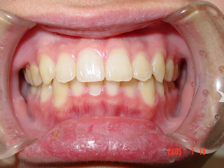 叢生（八重歯）の矯正治療後