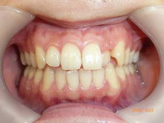 叢生（八重歯）の矯正治療前