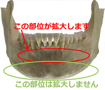 顎の拡大、歯槽骨、矯正歯科治療
