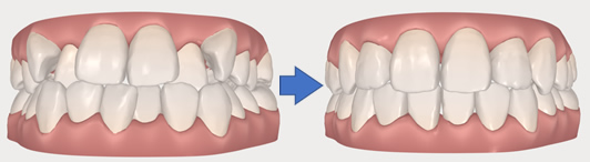 インビザライン簡易シュミレーション検査