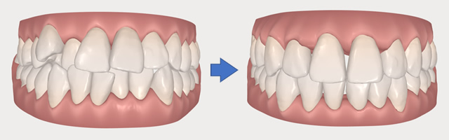 インビザラインのシミュレーション例1