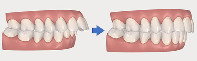 インビザラインのシミュレーション例2