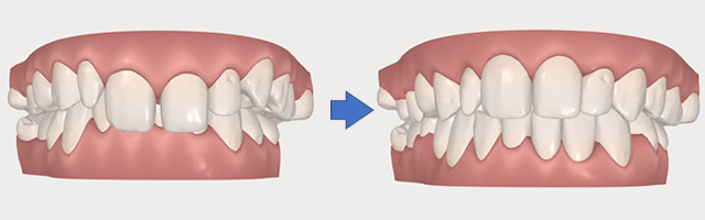 インビザラインのシミュレーション例3
