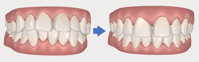 インビザラインのシミュレーション例5
